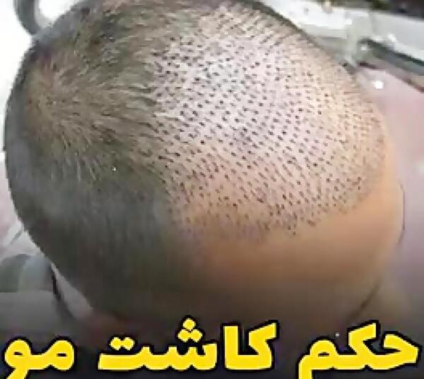 عکس حسین رفیعی قبل از کاشت مو