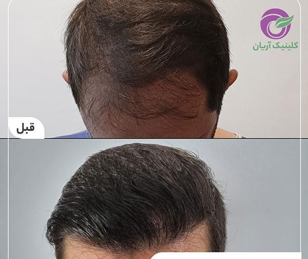 عکس محمد علیزاده قبل از کاشت مو