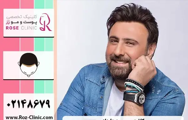 عکس محمد علیزاده قبل از کاشت مو