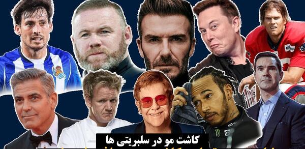 عکس محمد علیزاده قبل از کاشت مو
