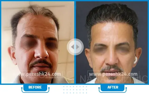 عکس محمد علیزاده قبل از کاشت مو