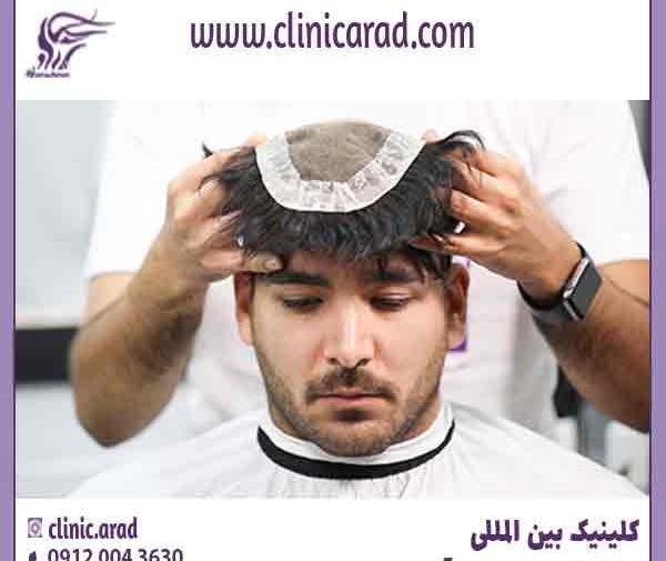 عکس محمد علیزاده قبل از کاشت مو