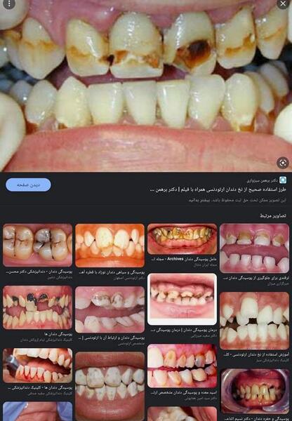 عکس قبل و بعد ارتودنسی نی نی سایت