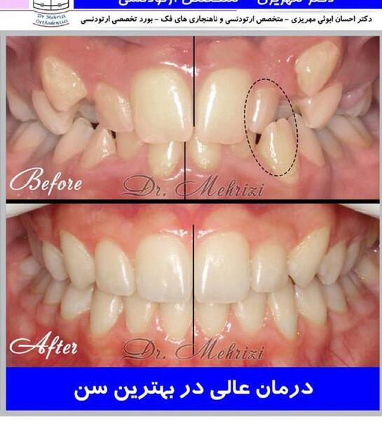 عکس قبل و بعد ارتودنسی نی نی سایت