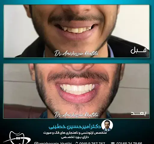 عکس قبل و بعد ارتودنسی نی نی سایت