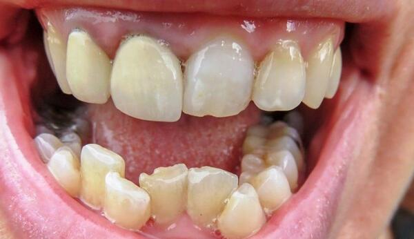 عکس قبل و بعد ارتودنسی نی نی سایت
