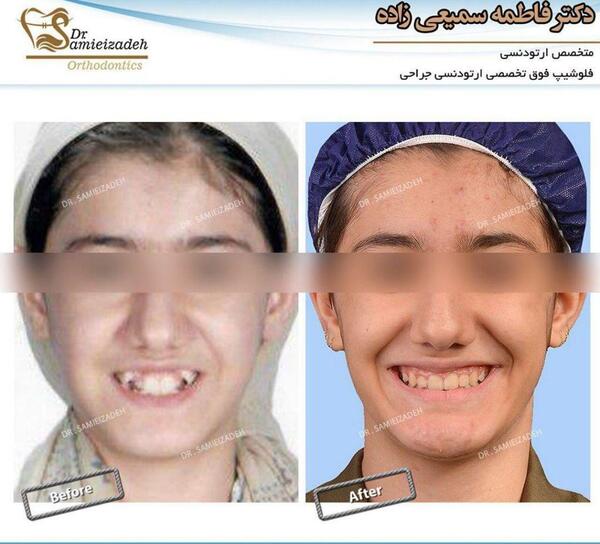 عکس قبل و بعد ارتودنسی نی نی سایت