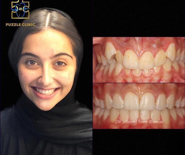 عکس قبل و بعد ارتودنسی نی نی سایت