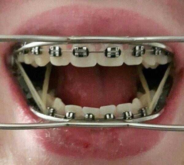 عکس قبل و بعد ارتودنسی نی نی سایت