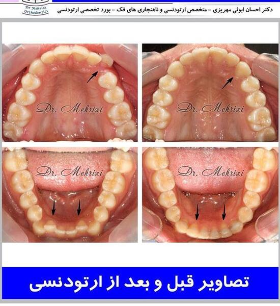 عکس قبل و بعد ارتودنسی دندان