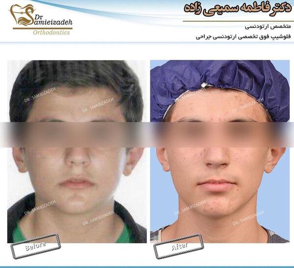 عکس قبل و بعد ارتودنسی دندان