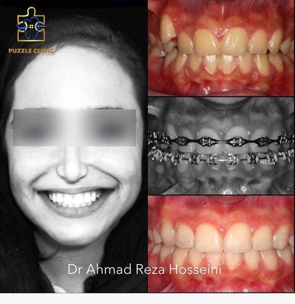 عکس قبل و بعد ارتودنسی دندان