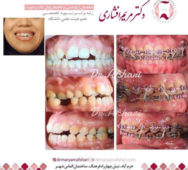 عکس قبل و بعد ارتودنسی دندان