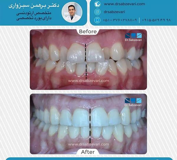 عکس قبل و بعد ارتودنسی دندان