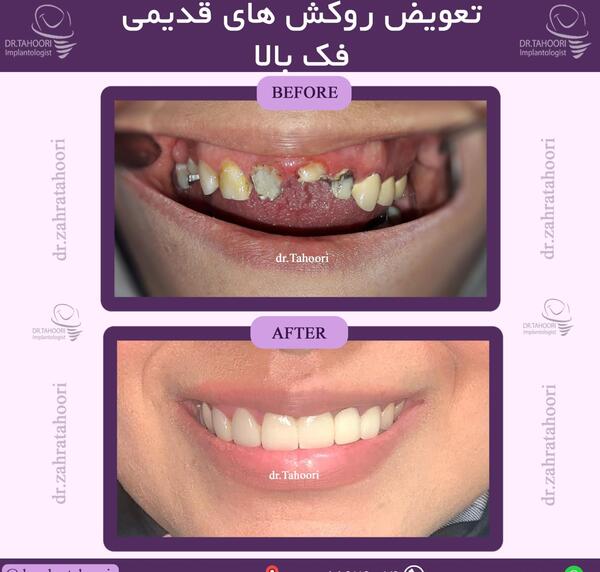عکس قبل و بعد ارتودنسی دندان