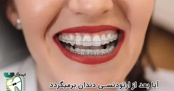 عکس قبل و بعد ارتودنسی با کشیدن دندان