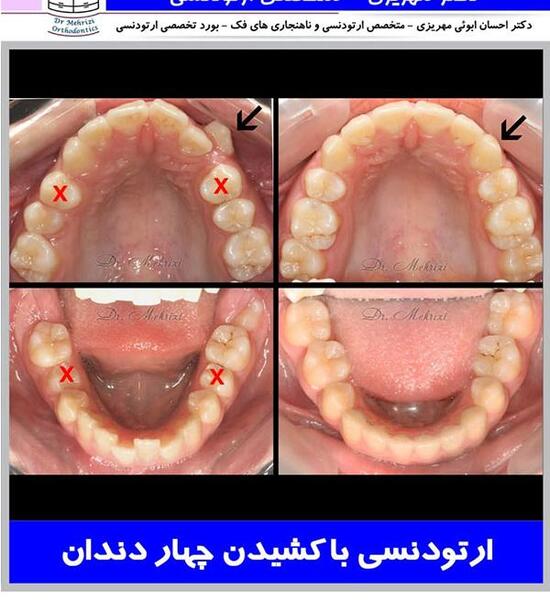 عکس قبل و بعد ارتودنسی با کشیدن دندان