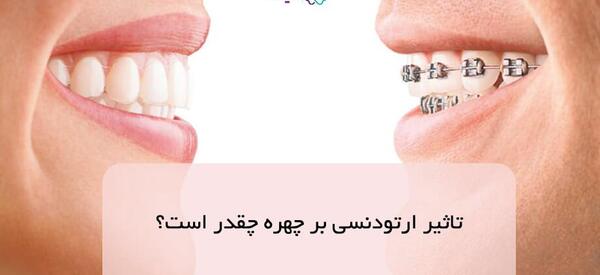 عکس قبل و بعد ارتودنسی با کشیدن دندان