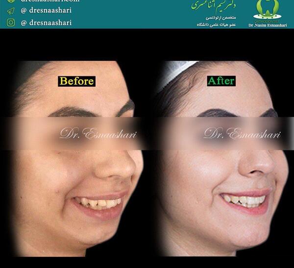 عکس قبل و بعد ارتودنسی با کشیدن دندان