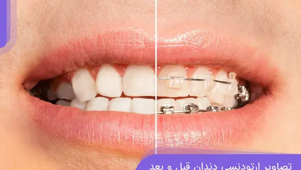 عکس قبل و بعد ارتودنسی نامرئی