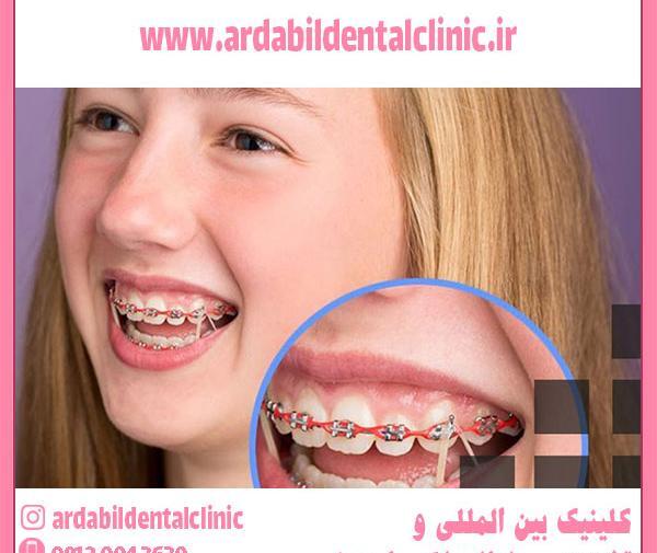 عکس قبل و بعد ارتودنسی نامرئی