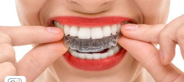 عکس قبل و بعد ارتودنسی نامرئی
