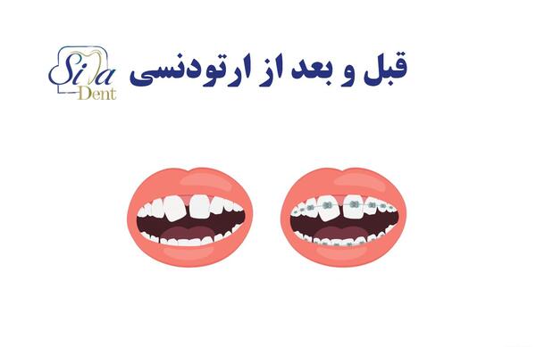 عکس قبل و بعد ارتودنسی نامرئی
