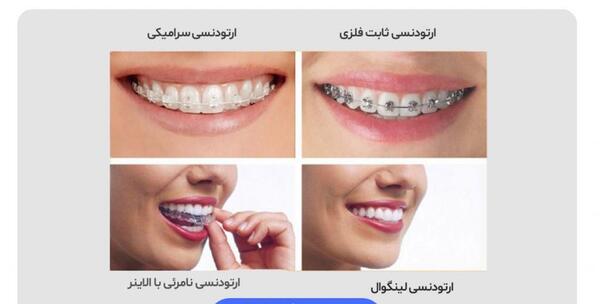 عکس قبل و بعد ارتودنسی نامرئی