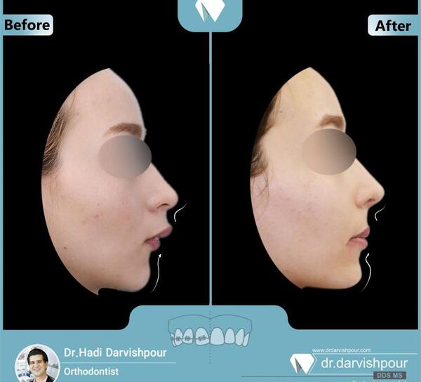 عکس قبل و بعد ارتودنسی نامرئی