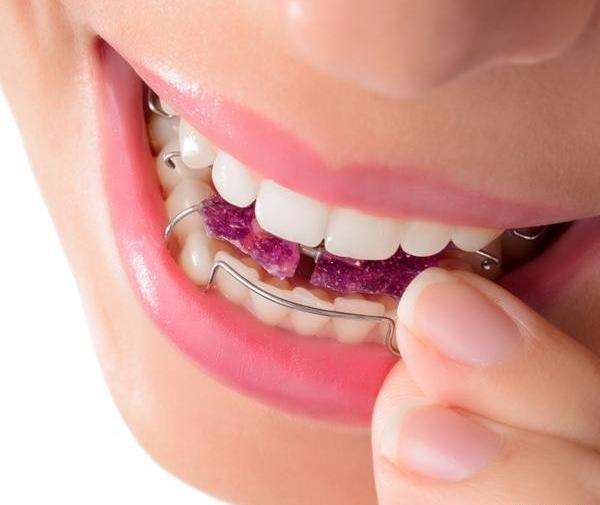 عکس قبل و بعد ارتودنسی نامرئی
