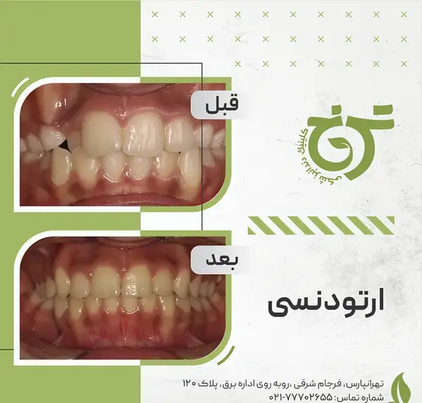 عکس قبل و بعد ارتودنسی نامرئی