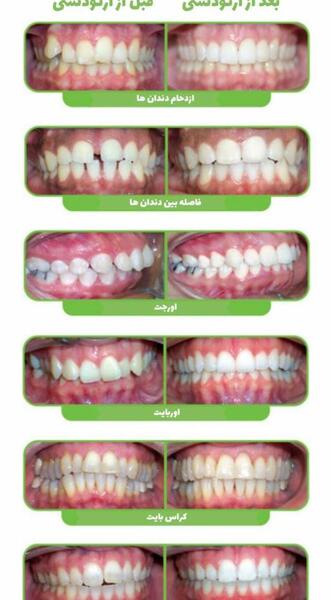 عکس قبل و بعد ارتودنسی نامرئی
