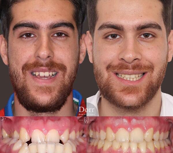 عکس های قبل و بعد ارتودنسی