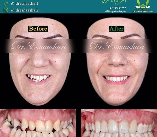 عکس های قبل و بعد ارتودنسی