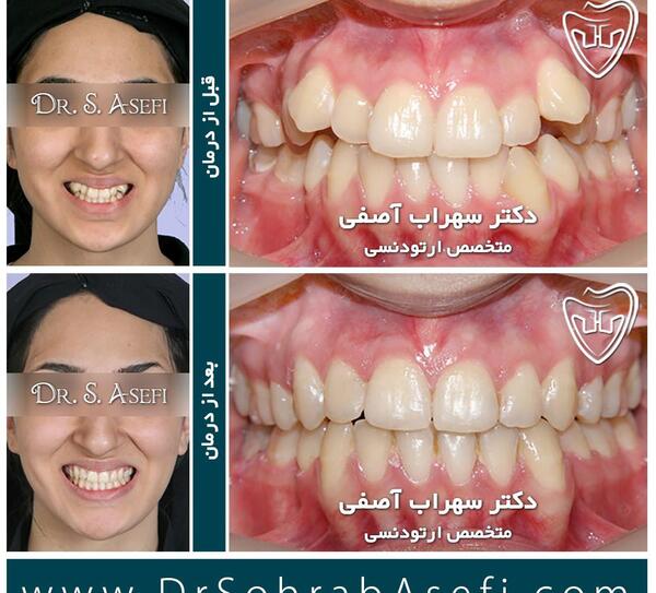 عکس های قبل و بعد ارتودنسی