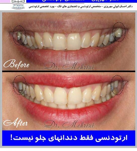 عکس های قبل و بعد ارتودنسی