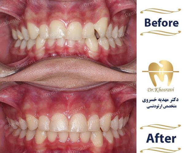 عکس های قبل و بعد ارتودنسی