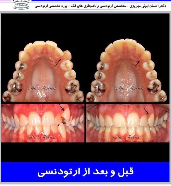 عکس قبل و بعد از ارتودنسی