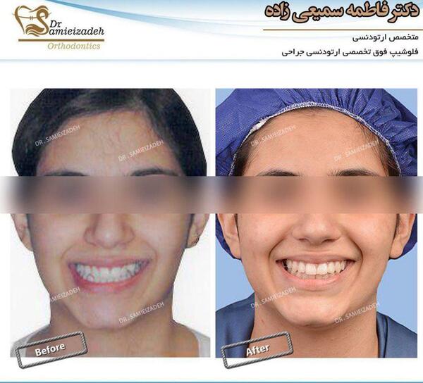 عکس قبل و بعد از ارتودنسی
