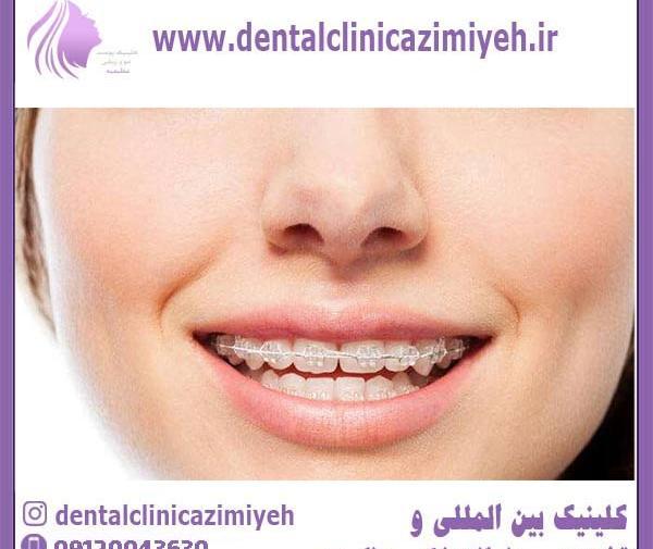 عکس قبل و بعد از ارتودنسی