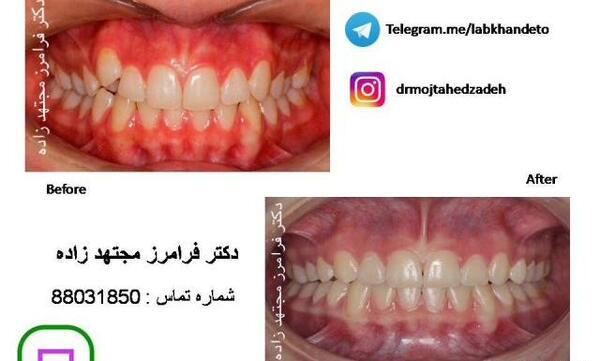 عکس قبل و بعد از ارتودنسی