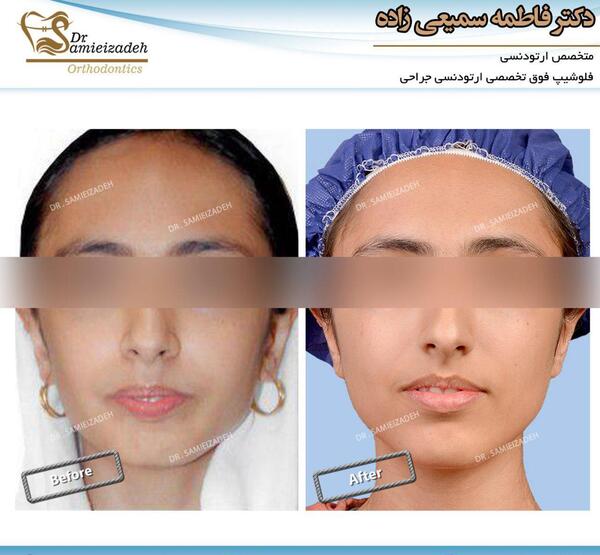 عکس قبل و بعد از ارتودنسی