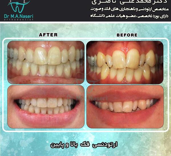عکس قبل و بعد از ارتودنسی