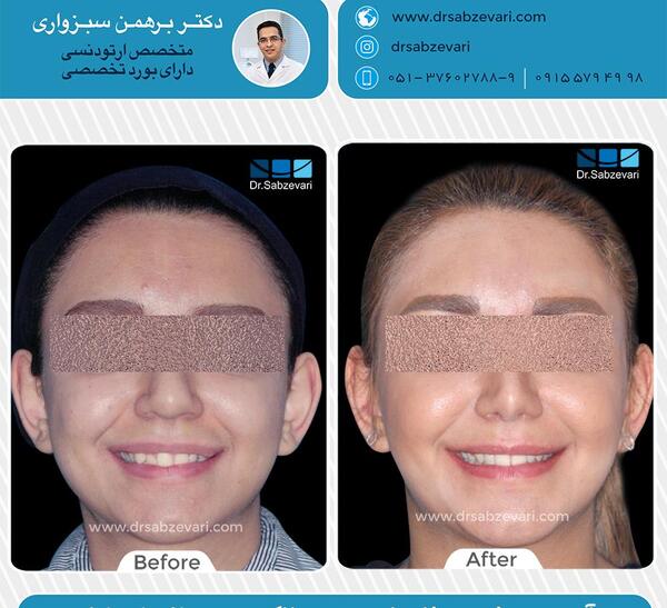 عکس قبل و بعد از ارتودنسی