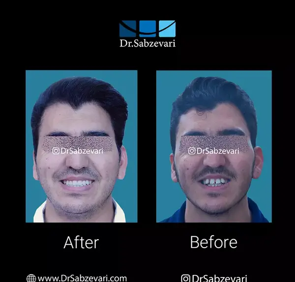 عکس قبل بعد ارتودنسی