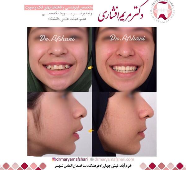 عکس قبل بعد ارتودنسی