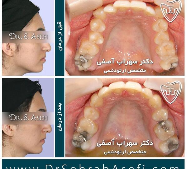 عکس قبل بعد ارتودنسی