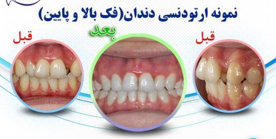 عکس قبل بعد ارتودنسی