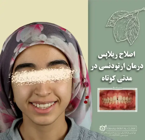 عکس قبل بعد ارتودنسی