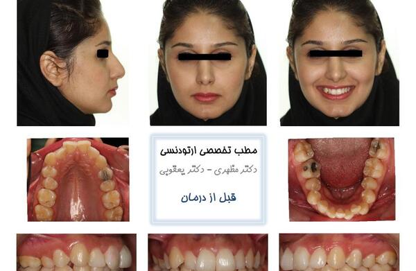 عکس قبل بعد ارتودنسی